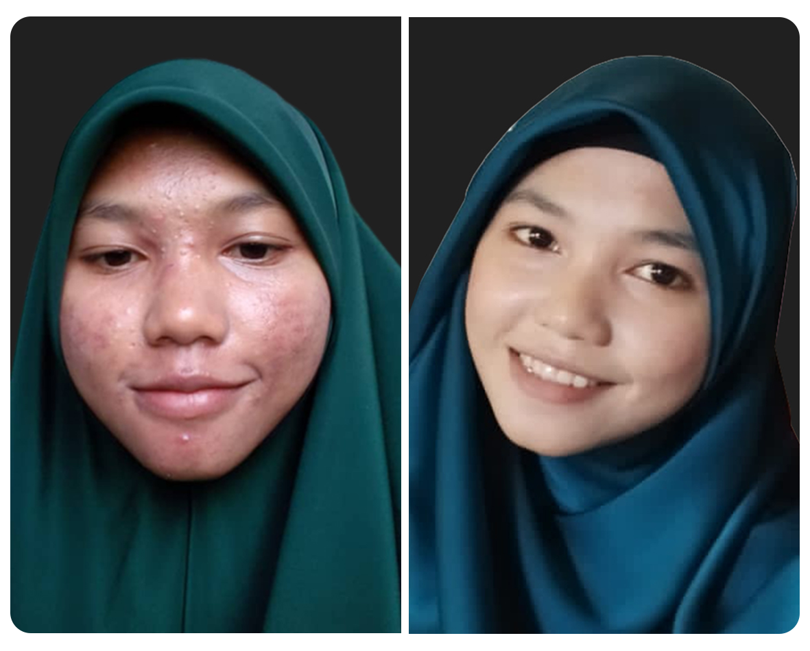 Before and after pengguna Gluvy 3