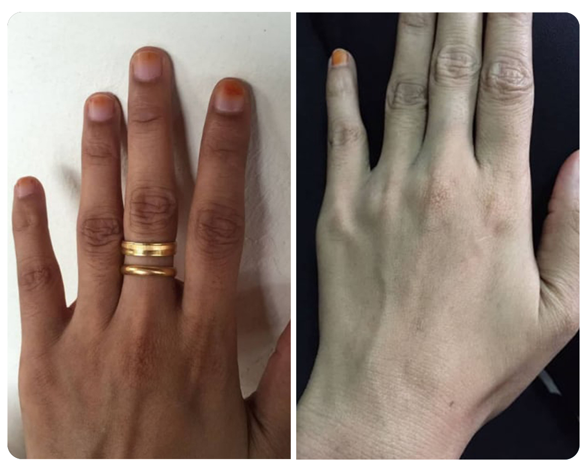 Before and after pengguna Gluvy 4